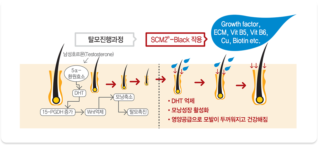 안트로젠 두피메조 치료 과정